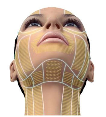 Visuelle Darstellung der Gesichtsstruktur während eines HIFU Facelifts mit hervorgehobenen Linien, die die Bereiche für die Ultraschallenergie-Einwirkung anzeigen.