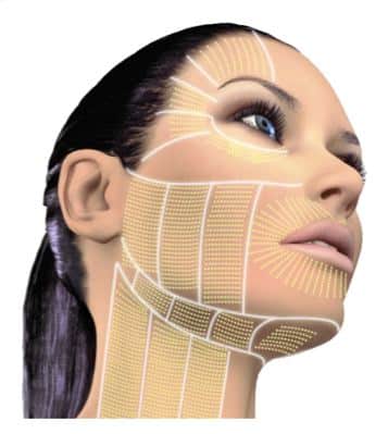 Diagramm einer HIFU Face Lift-Prozedur, das die Zielbereiche auf der Gesichtshaut zeigt.